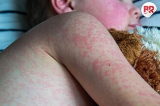 Usa hit by measles outbreak: 2 children dead, over 600 cases reported – know the symptoms, vaccine, and treatment