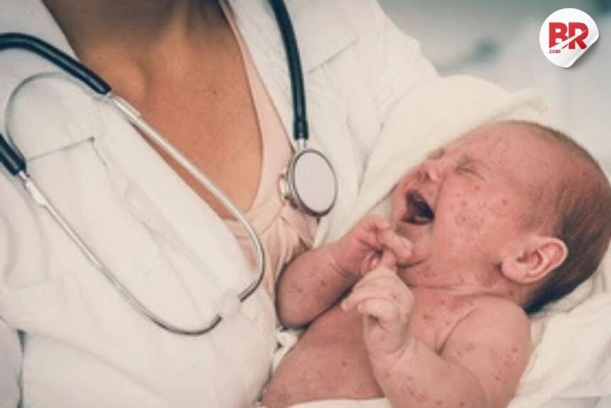 Measles in newborns: canada sees rise in congenital cases